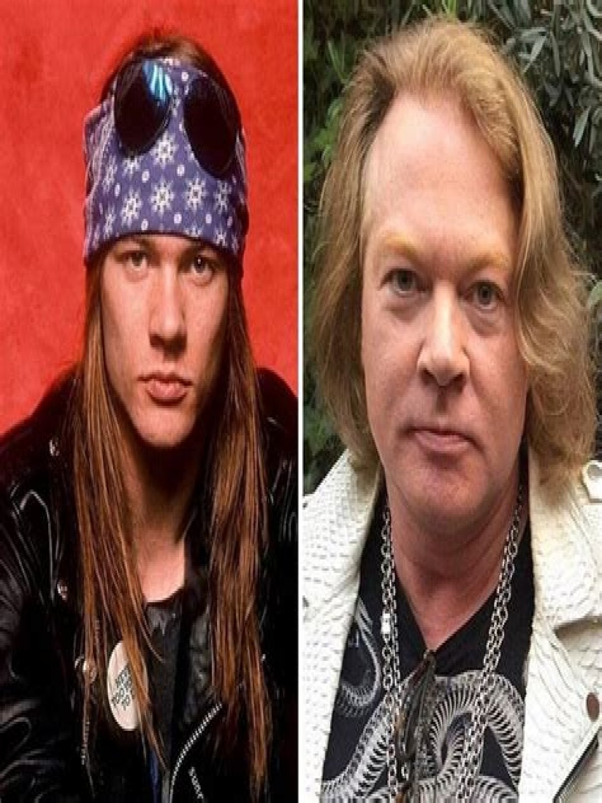 Axl Rose Plastic Surgery: Unveiling The Transformation Of A Rock Icon